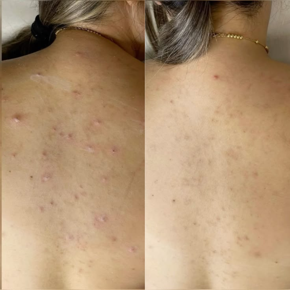 Peau plus lisse, dos plus clean